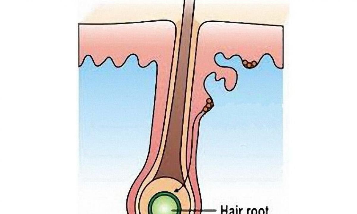 We define the cause of pain of roots of hair